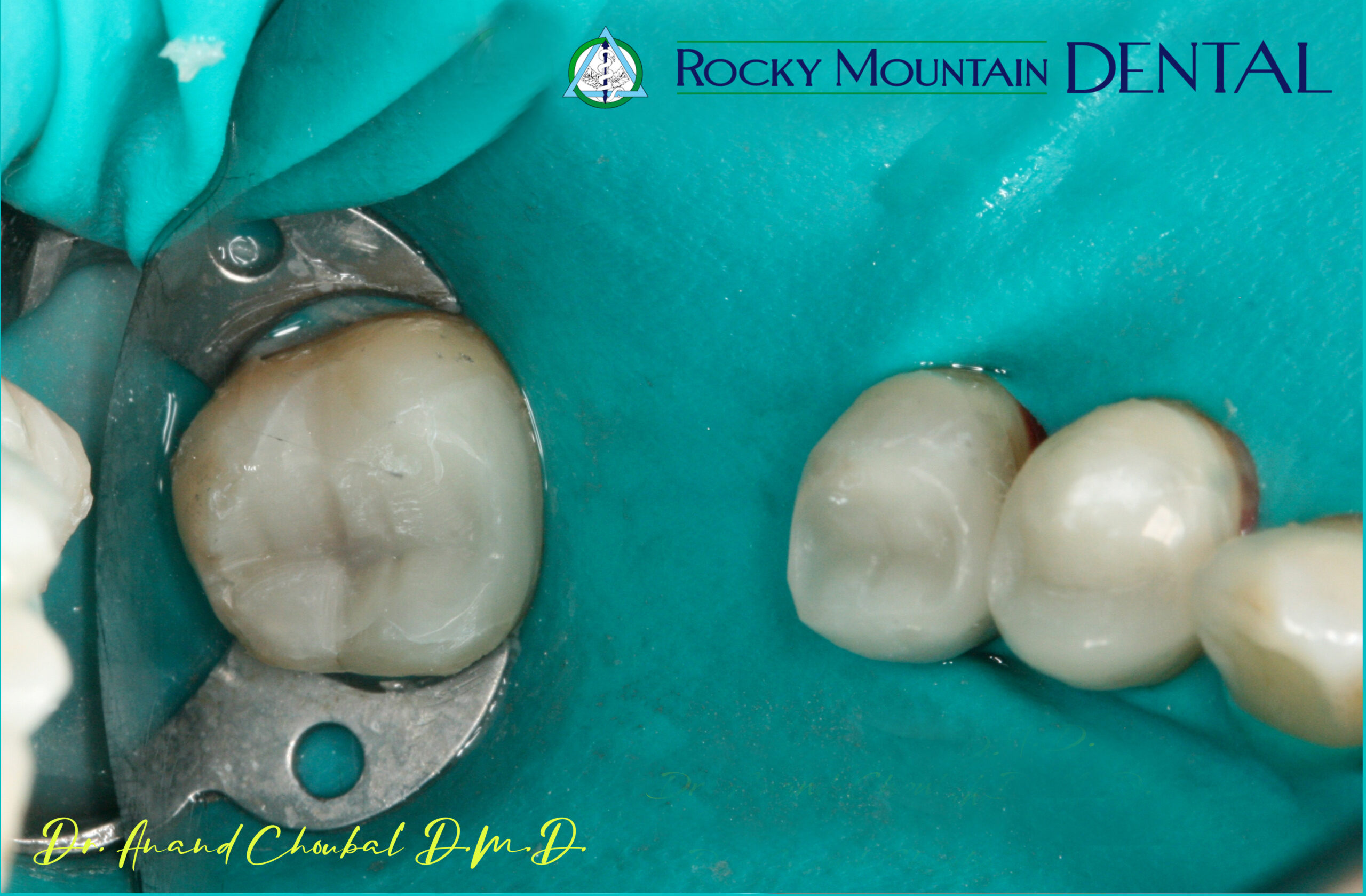 Complete Smile Makeover