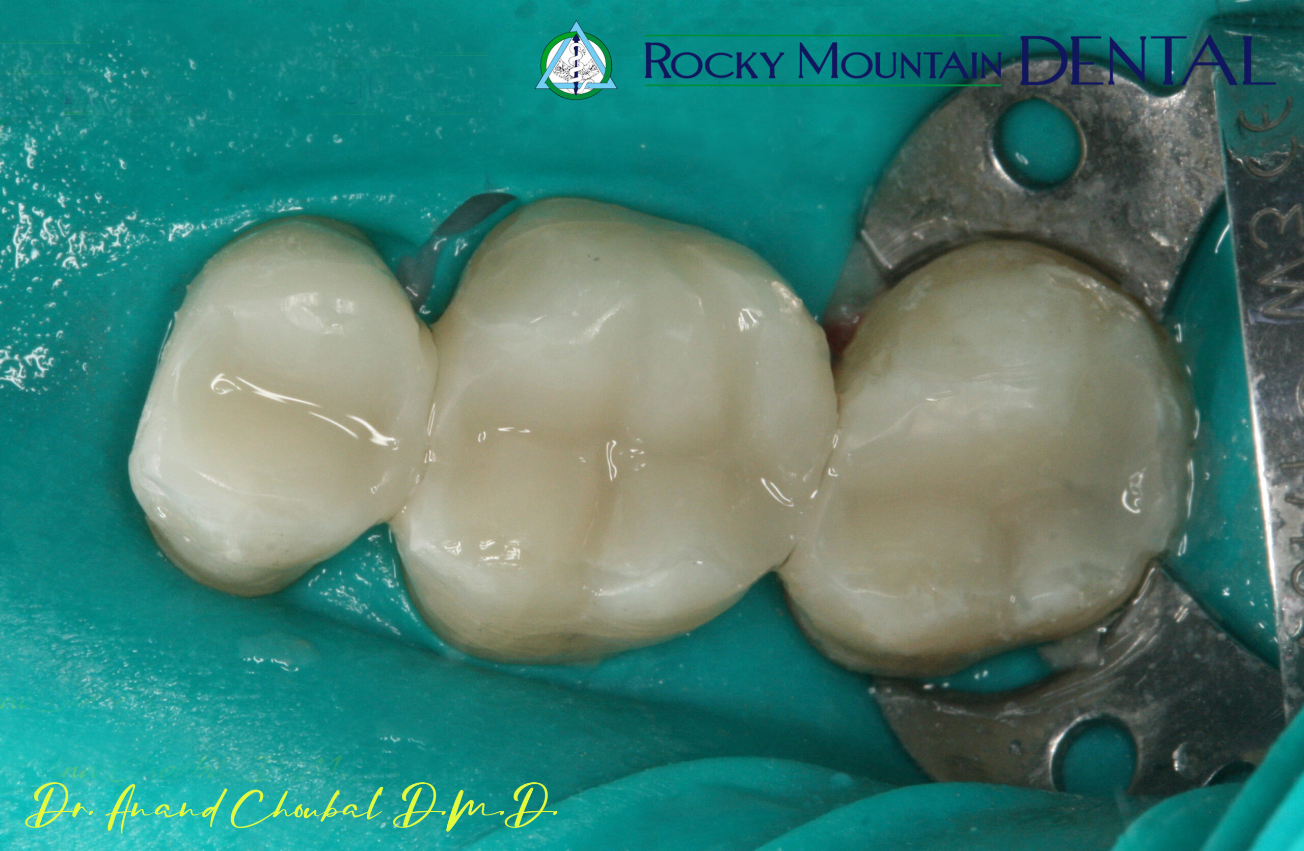 Implant-supported tooth restoration at Rocky Mountain Dental