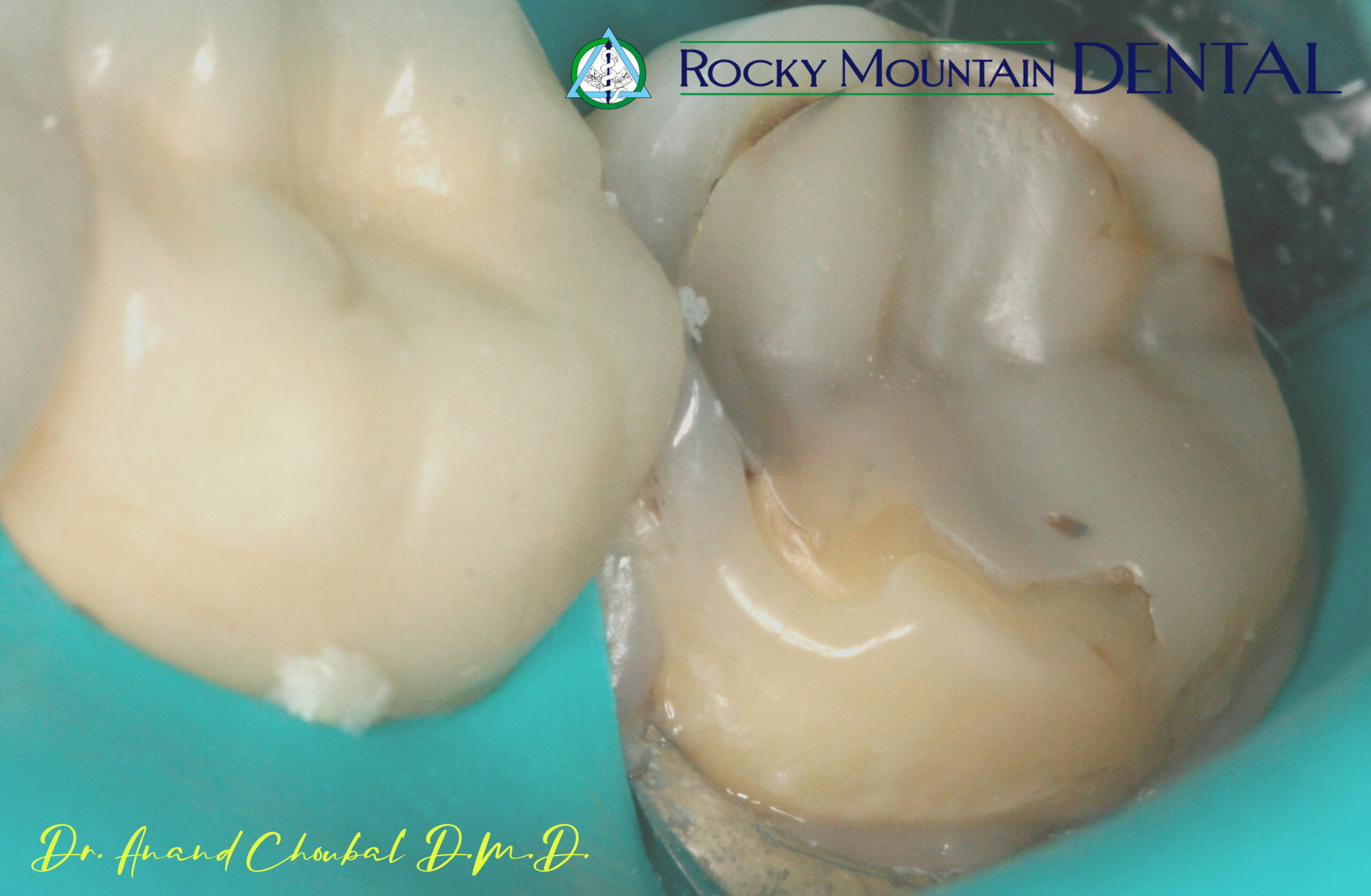 Invisalign Transformation